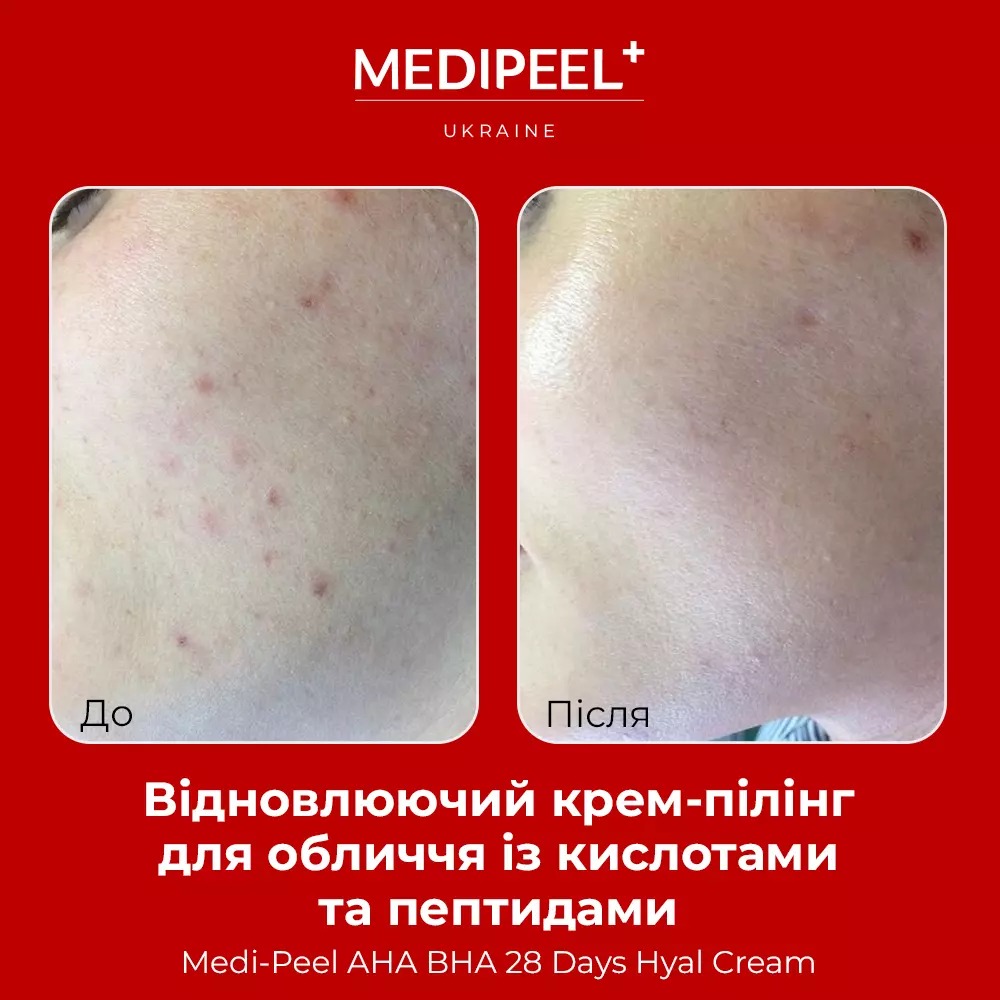 Крем-пилинг Medi-Peel AHA BHA 28 Days Hyal Cream восстанавливающий с кислотами и пептидами 30 мл - фото 4