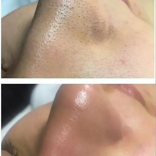 Ультразвуковий скрабер для очищення обличчя Ultrasonic Shovel Beauty Start - фото 5