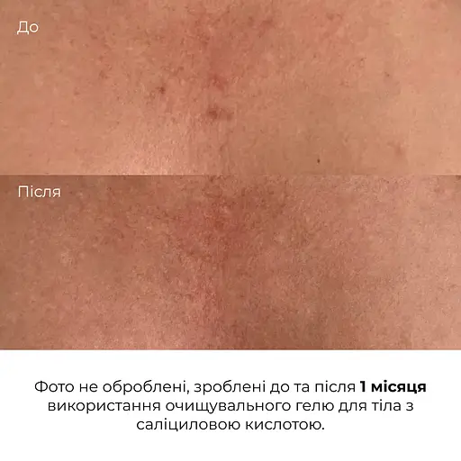 Очищувальний гель для тіла з саліциловою кислотою Hillary Anti-Acne Salicylic Body Wash 200 мл - фото 8