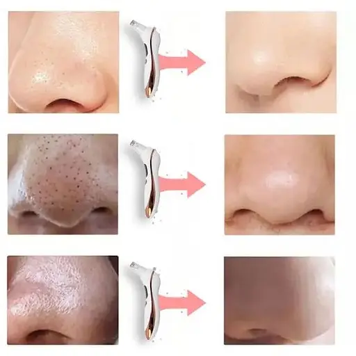 Очисник шкіри BS-810 від чорних цяток вакуумний - фото 7