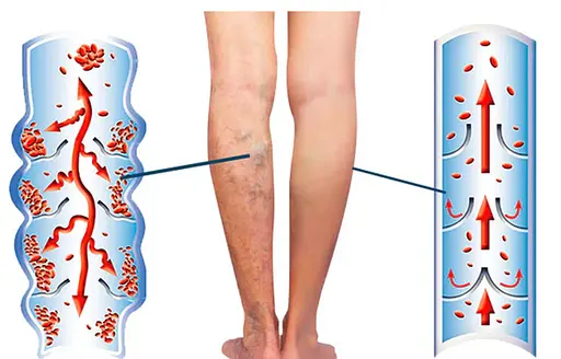 Крем от варикозного расширения вен и сосудистых звездочек для кровообращения 20 г, 1 шт - фото 5