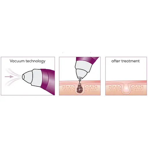 Масажер Beurer для обличчя вакуумний, акумулятор, USB, 3 режими, білий - фото 7