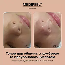 Тонер для обличчя Medi-Peel Hyal Kombucha Tea-Tox Toner з комбучею та гіалуроновою кислотою 150 мл - мініатюра 4