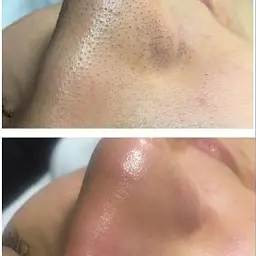 Ультразвуковий скрабер для очищення обличчя Ultrasonic Shovel Beauty Start - мініатюра 5