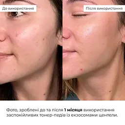 Комплекс Hillary з центеллою для заспокоєння та відновлення чутливої шкіри - мініатюра 2