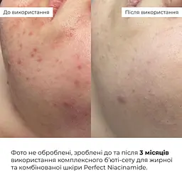 Комплексний б’юті-сет Perfect Niacinamide Sebo Balance Hillary для жирної та комбінованої шкіри - мініатюра 4