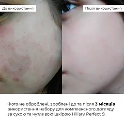 Набір Hillary для комплексного догляду за сухою та чутливою шкірою 9 - мініатюра 2