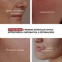 Комплекс Hillary нічного догляду для себорегуляції та корекції висипань - мініатюра 14