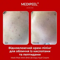 Крем-пілінг для обличчя  Medi-Peel AHA BHA 28 Days Hyal Cream відновлювальний з кислотами та пептидами 30 мл - мініатюра 4