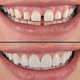 Вініри зубні Perfect Smile Veneers змінні White (kz059) - мініатюра 4