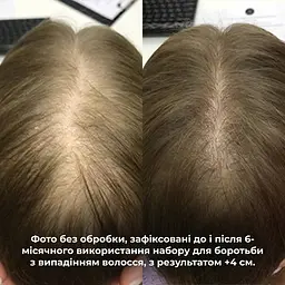 Шампунь Hillary Serenoa & РР Hair Loss Control проти випадіння волосся 250 мл - мініатюра 13
