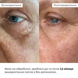 Розгладжувальні патчі з біо-ретинолом Hillary Bacuchiol Wrinkle Correcting & Eye Lift Patches 60 шт. - мініатюра 12