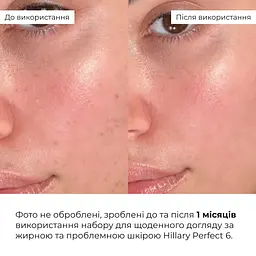 Набір Hillary для щоденного догляду за жирною та проблемною шкірою 6 - мініатюра 2