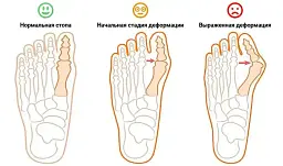 Магнітна вальгусна шина RELAX FOOT (Magnet Fix) Магнітний коректор стопи - мініатюра 7