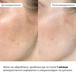 Мультисироватка Hillary Multi Niacinamid serum  з ніацинамідом та цинком 30 мл - мініатюра 10