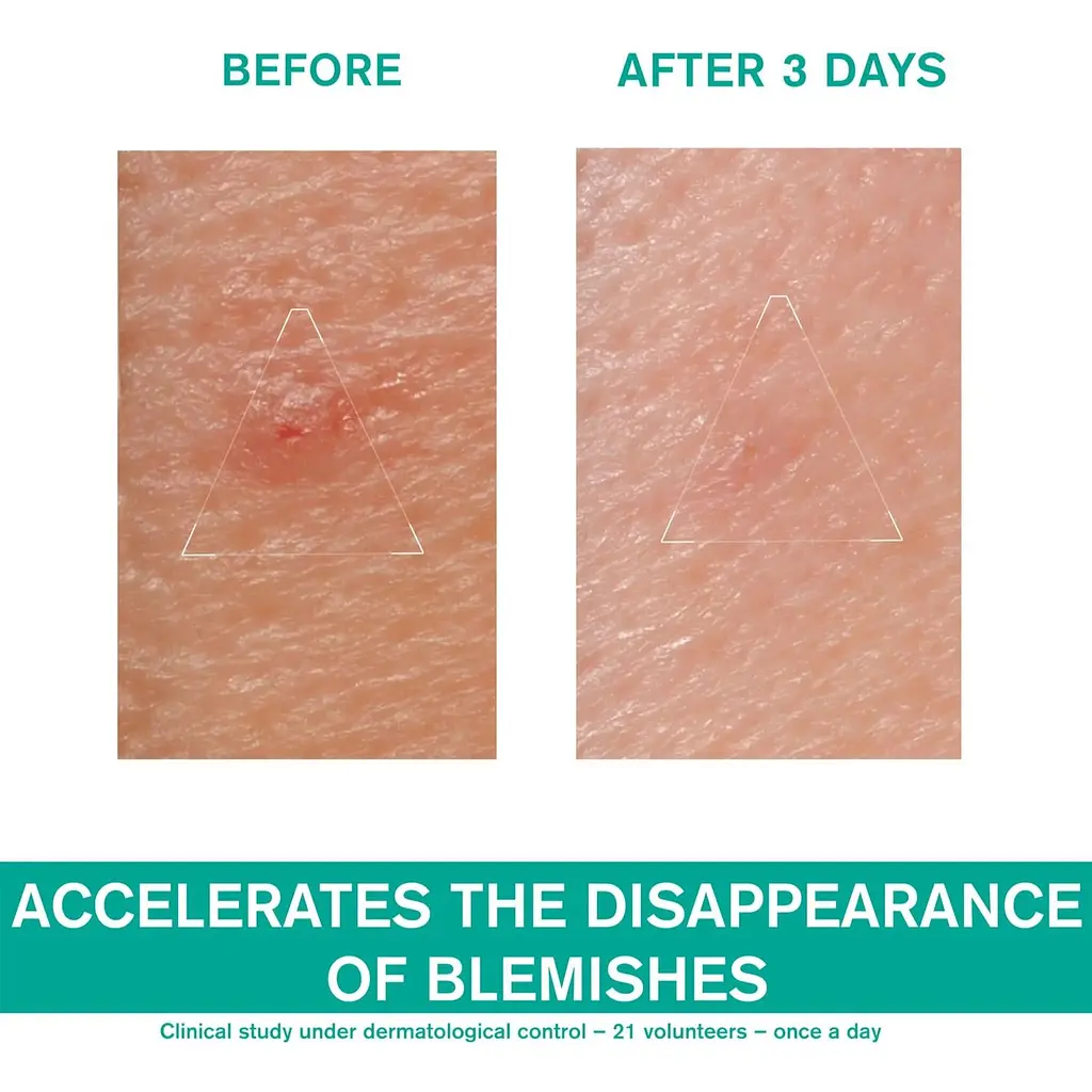 Паста от сыпи Uriage Eau Thermale SOS-уход для жирной и проблемной кожи 15 мл - фото 8