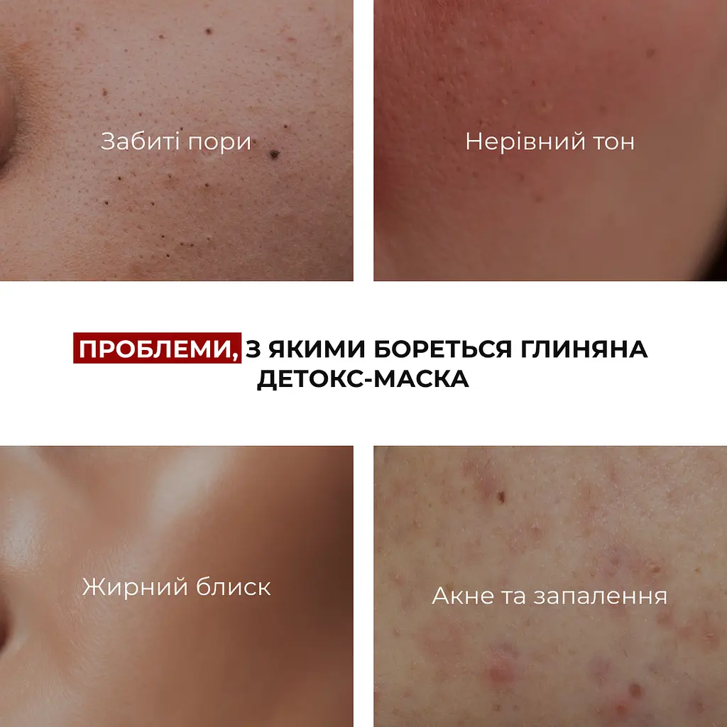 Глиняная детокс-маска для проблемной кожи лица Anti-Acne & Detox Clay Mask Hillary 90 мл - фото 7