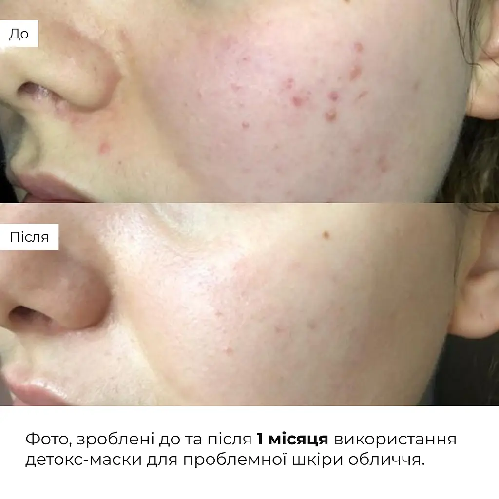 Глиняная детокс-маска для проблемной кожи лица Anti-Acne & Detox Clay Mask Hillary 90 мл - фото 4