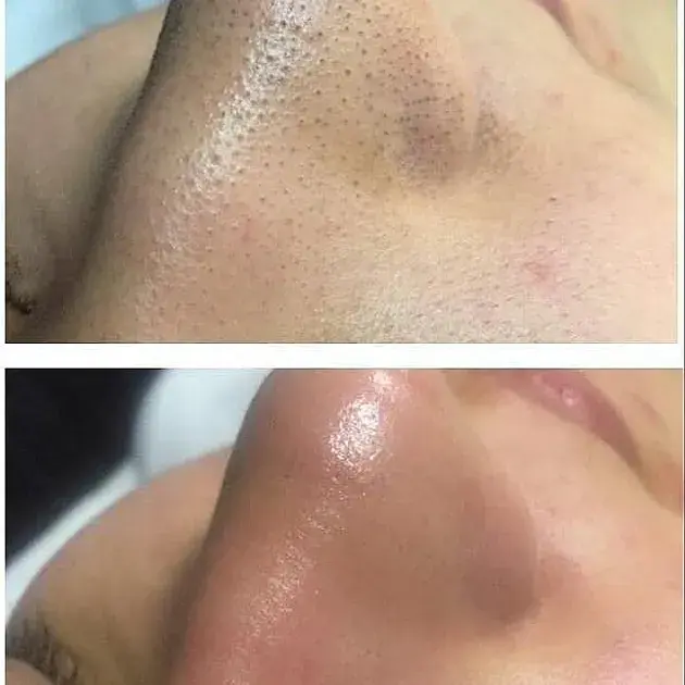 Ультразвуковий скрабер для очищення обличчя Ultrasonic Shovel Beauty Start - фото 5