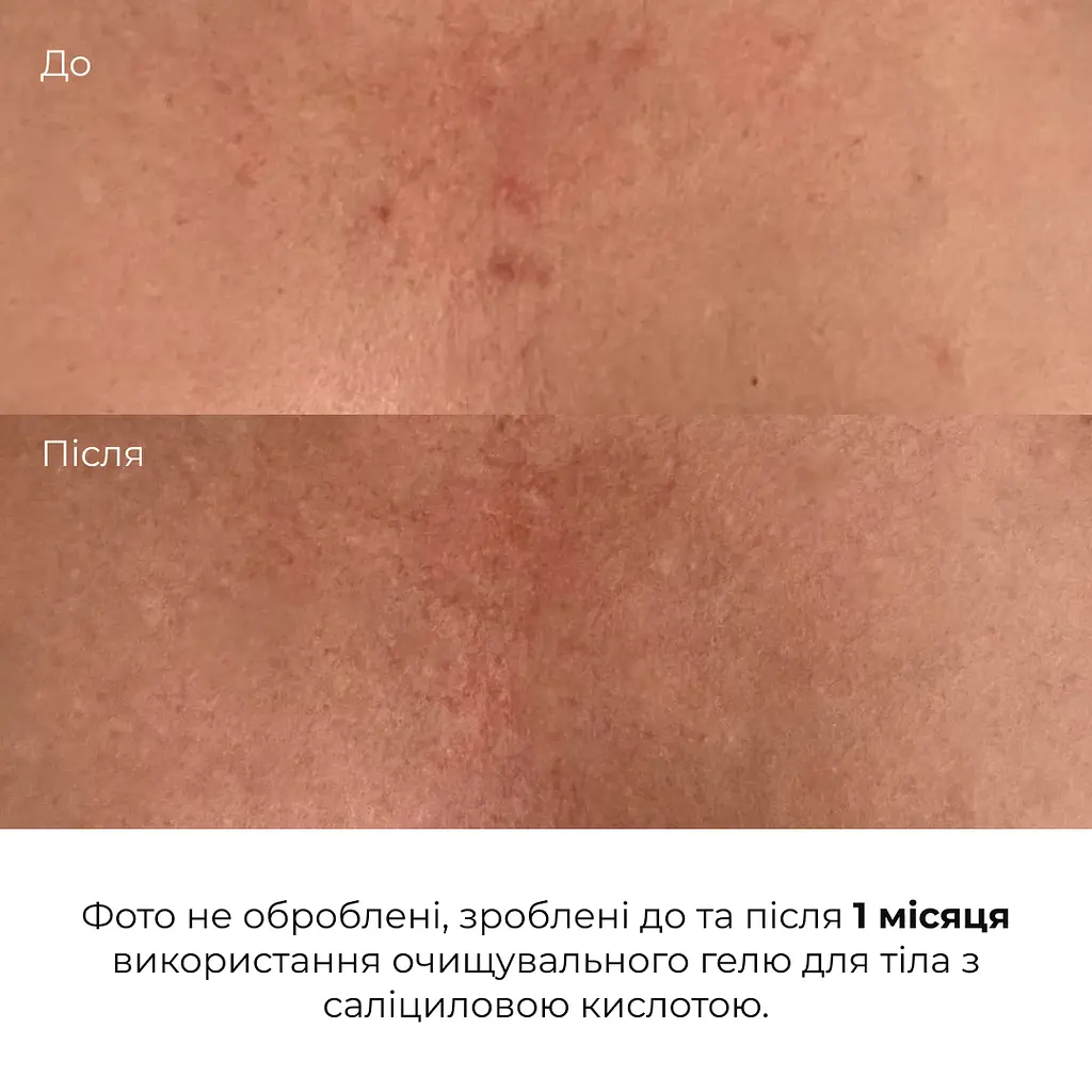 Очищувальний гель для тіла з саліциловою кислотою Anti-Acne Salicylic Body Wash Hillary 200 мл - фото 8