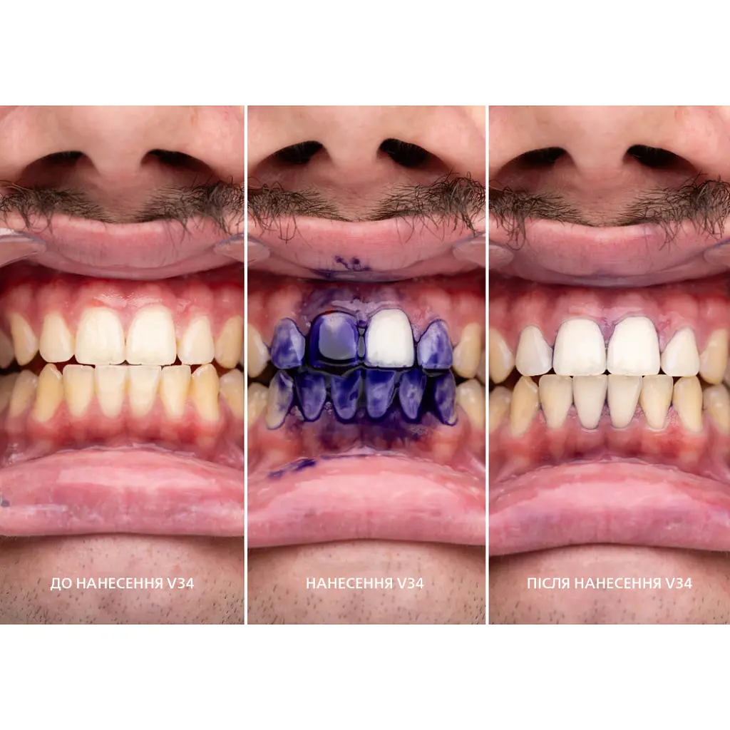 Засіб для відбілювання зубів SmileKit V34 Коректор кольору зубів 30 мл (5.3010) - фото 9