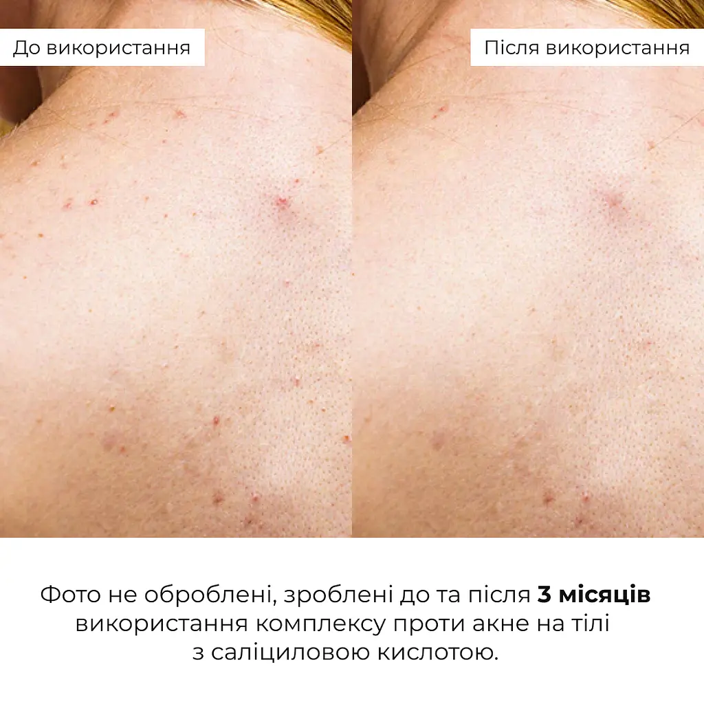 Сироватка для проблемної шкіри з саліциловою кислотою Back & Body Acne Control serum Hillary 50 мл - фото 7