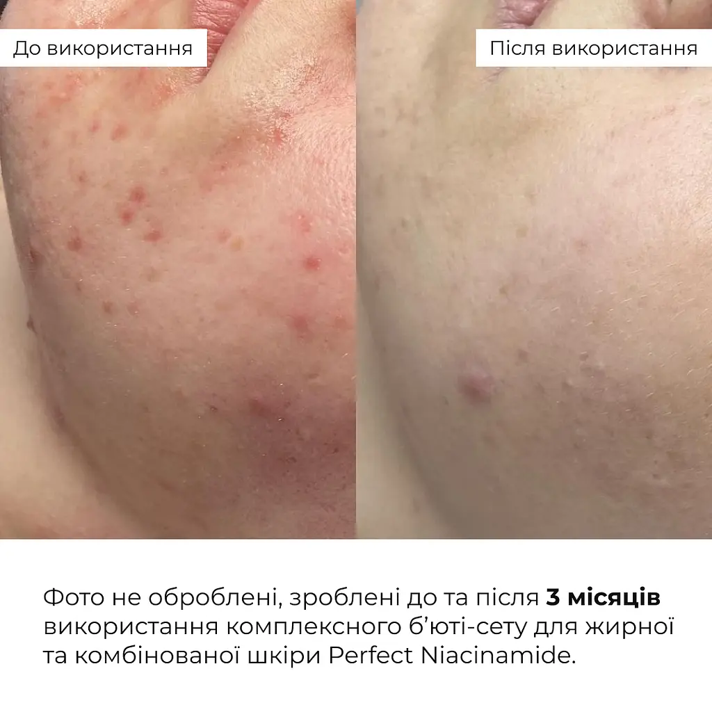 Комплексний б’юті-сет Perfect Niacinamide Sebo Balance Hillary для жирної та комбінованої шкіри - фото 4