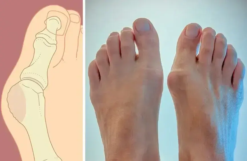 Магнітна вальгусна шина RELAX FOOT (Magnet Fix) Магнітний коректор стопи - фото 8