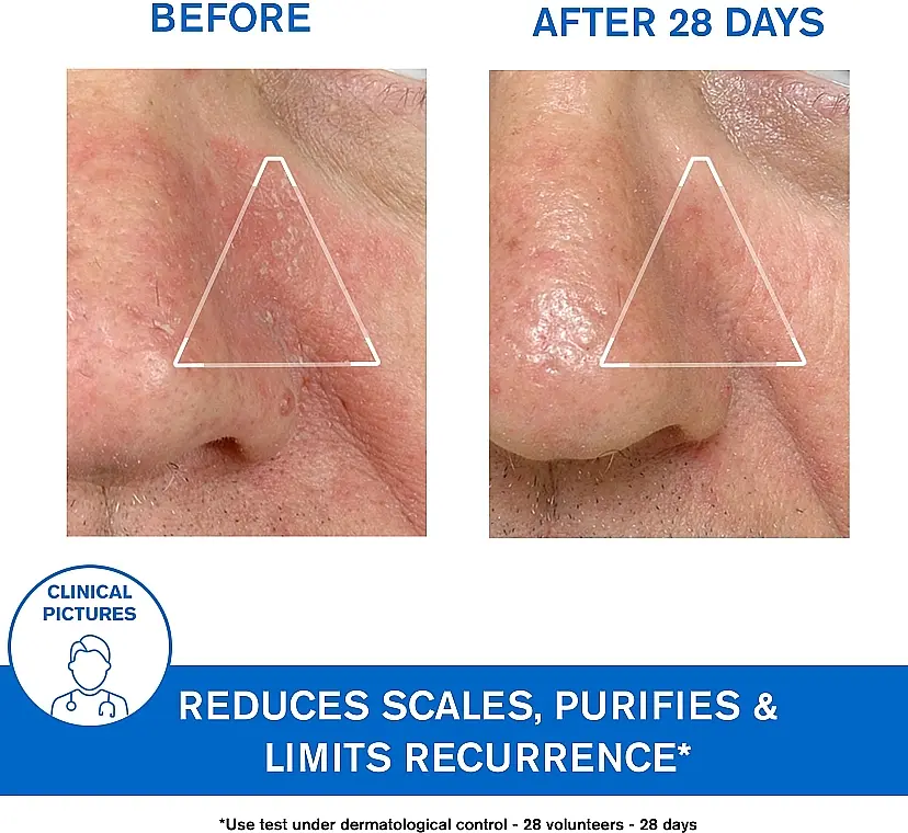 Успокаивающая эмульсия Uriage DS Regulating Soothing Emulsion против себорейного дерматита 40 мл - фото 7