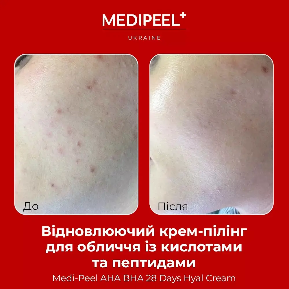 Крем-пілінг для обличчя  Medi-Peel AHA BHA 28 Days Hyal Cream відновлювальний з кислотами та пептидами 30 мл - фото 4