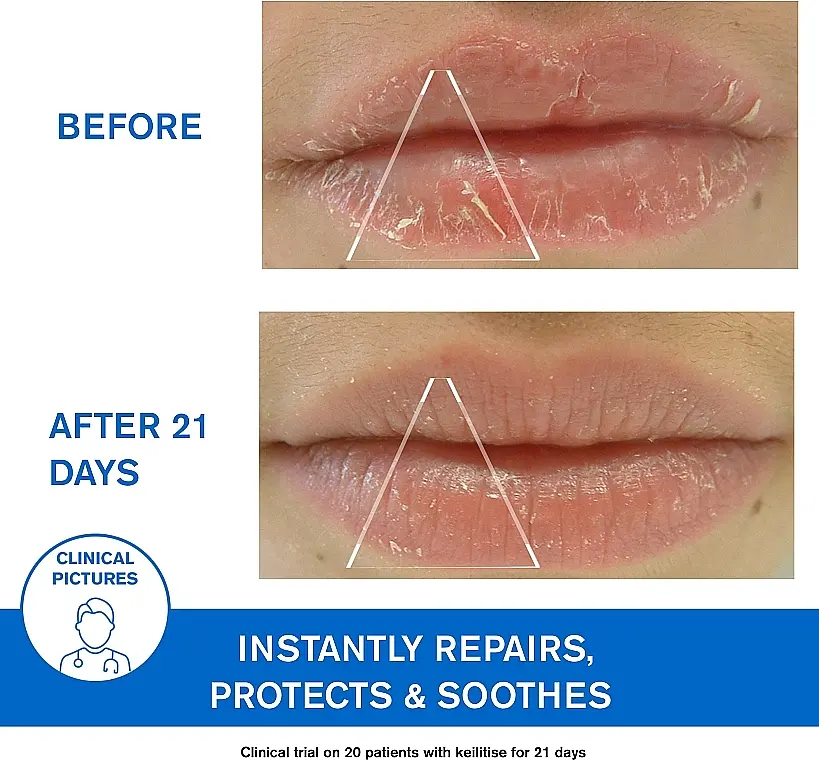 Успокаивающая эмульсия Uriage DS Regulating Soothing Emulsion против себорейного дерматита 40 мл - фото 6