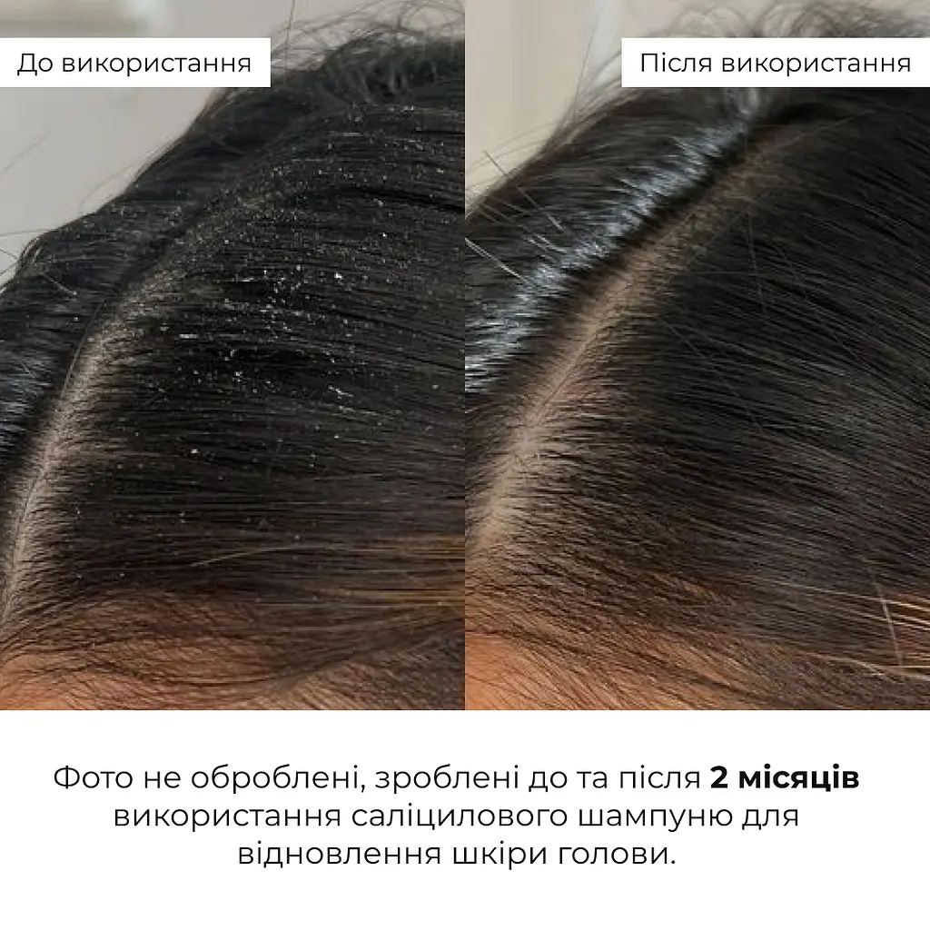Салициловый шампунь для восстановления кожи головы Salicylic Scalp Reset Shampoo Hillary 400 мл - фото 2
