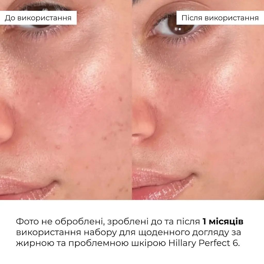 Набір Hillary для щоденного догляду за жирною та проблемною шкірою 6 - фото 2