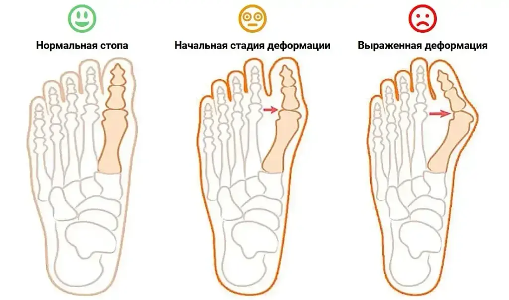 Магнітна вальгусна шина RELAX FOOT (Magnet Fix) Магнітний коректор стопи - фото 7